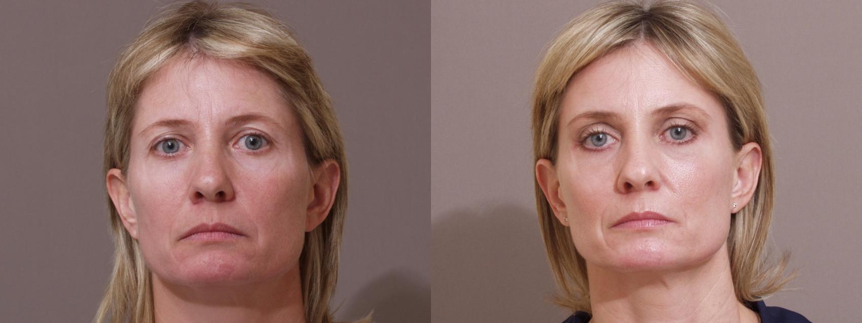Eyelid Surgery Case 77 Before & After View #1 | Webster, TX | Houston Plastic and Reconstructive Surgery