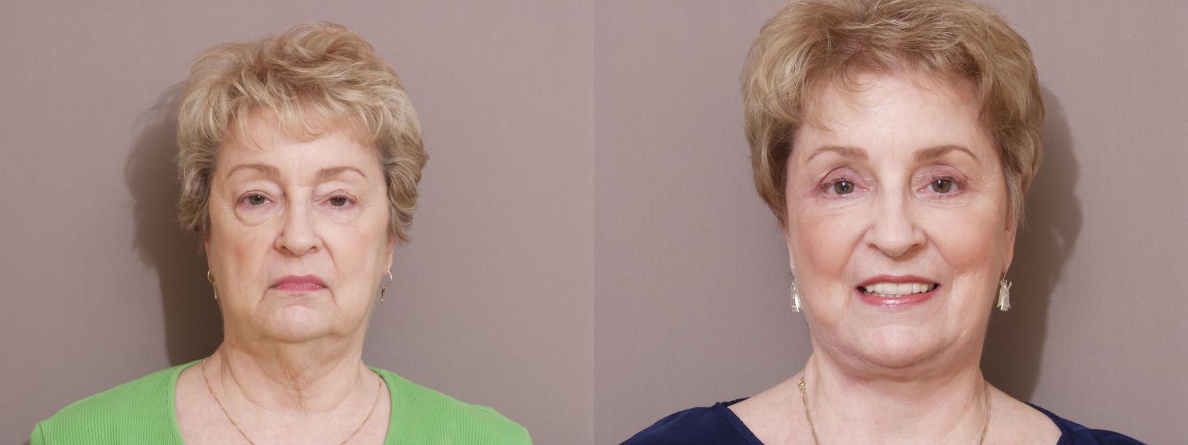 Facelift Case 114 Before & After View #1 | Webster, TX | Houston Plastic and Reconstructive Surgery