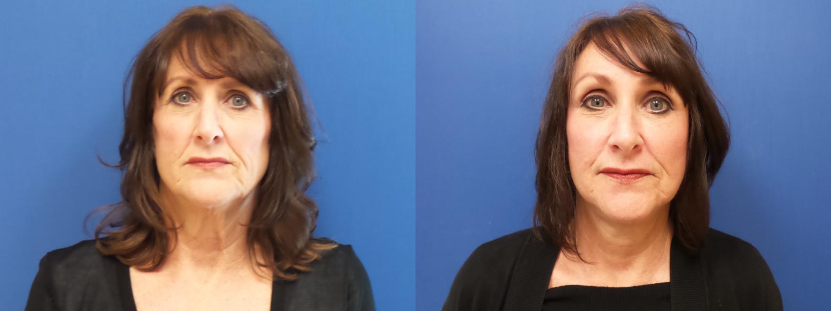 Facelift Case 241 Before & After View #1 | Webster, TX | Houston Plastic and Reconstructive Surgery