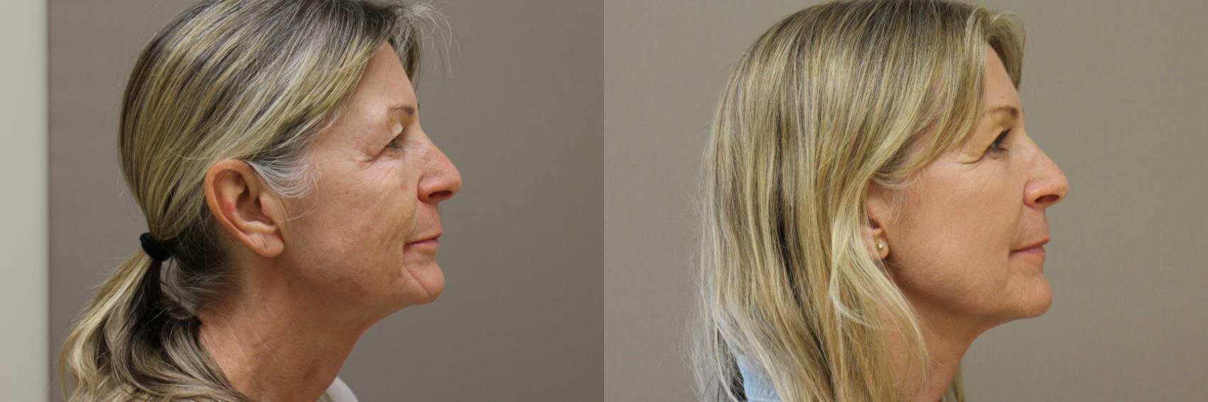 Lasers & Lights Case 178 Before & After View #2 | Webster, TX | Houston Plastic and Reconstructive Surgery