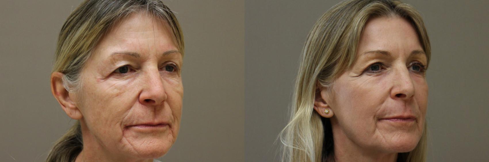 Lasers & Lights Case 178 Before & After View #3 | Webster, TX | Houston Plastic and Reconstructive Surgery