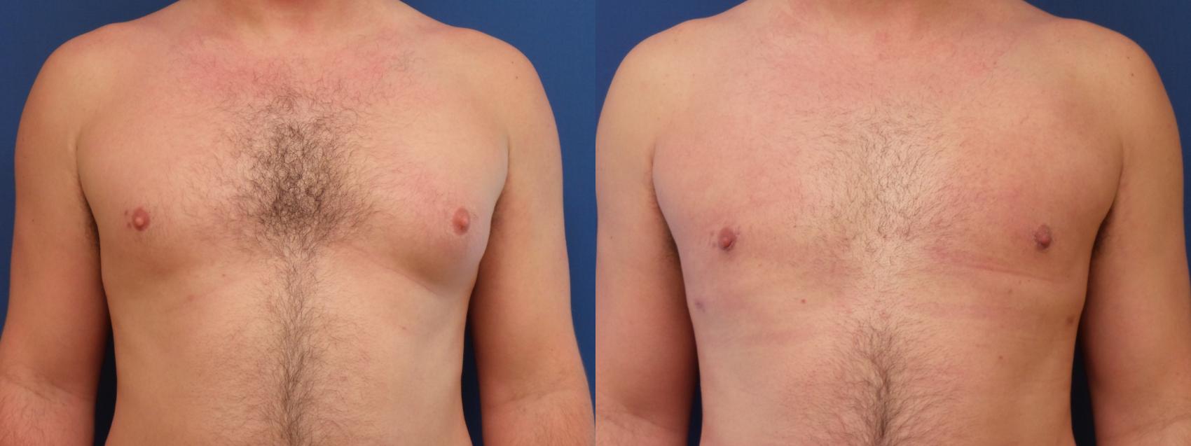Male Breast Reduction Case 191 Before & After View #1 | Webster, TX | Houston Plastic and Reconstructive Surgery