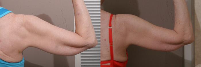 Arm Lift Case 103 Before & After View #2 | Webster, TX | Houston Plastic and Reconstructive Surgery