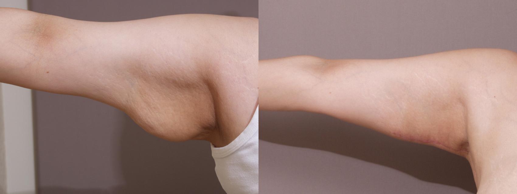 Arm Lift in Webster, TX  Houston Plastic & Reconstructive Surgery