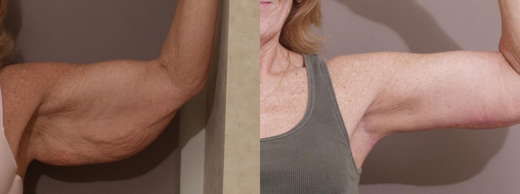 A before and after view of a successful brachioplasty procedure. An untoned  arm is seen on