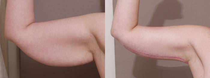 Arm Lift Case 14 Before & After View #1 | Webster, TX | Houston Plastic and Reconstructive Surgery