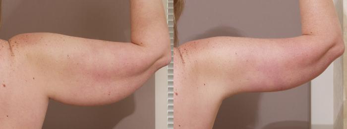 Arm Lift Case 14 Before & After View #2 | Webster, TX | Houston Plastic and Reconstructive Surgery