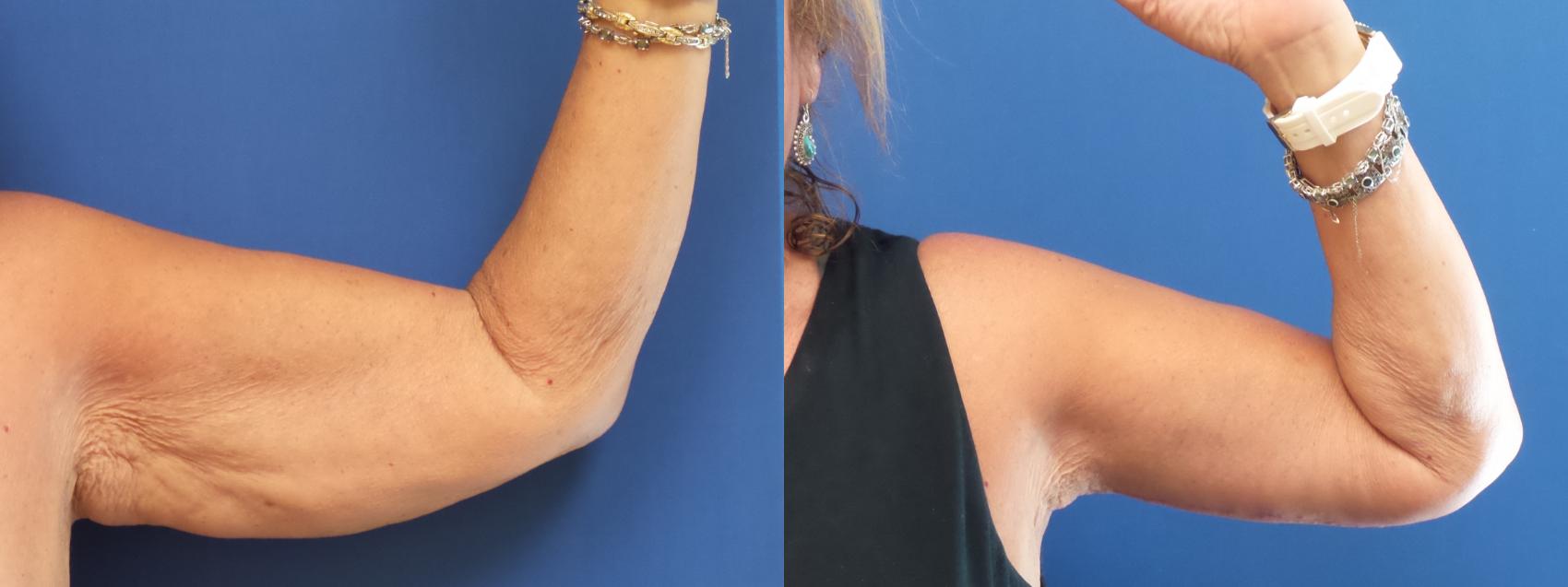 Get Rid of Flabby Arms With an Arm Lift in Lubbock