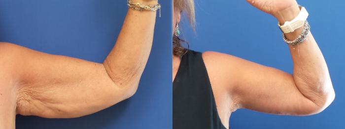 Arm Lift Case 171 Before & After View #1 | Webster, TX | Houston Plastic and Reconstructive Surgery