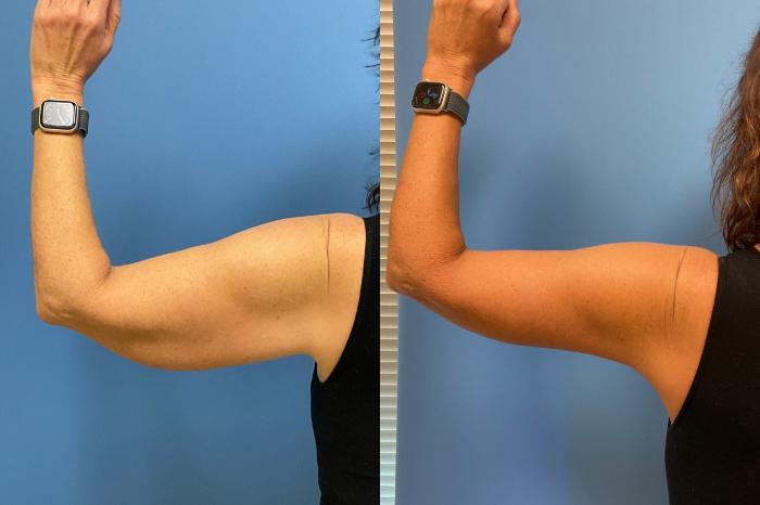Arm Lift Case 300 Before & After Back (Left Arm) | Webster, TX | Houston Plastic and Reconstructive Surgery