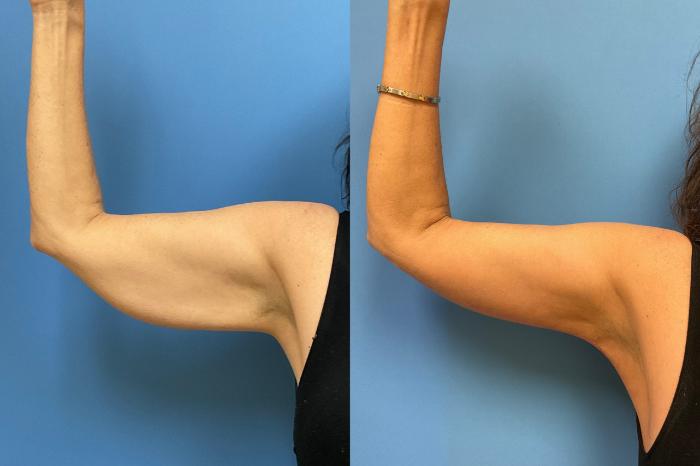 Arm Lift Case 300 Before & After Front (Right Arm) | Webster, TX | Houston Plastic and Reconstructive Surgery