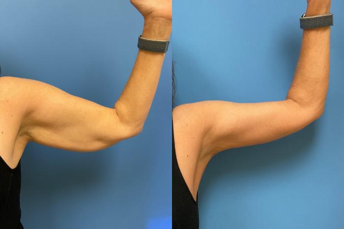 Arm Lift Case 300 Before & After Front | Webster, TX | Houston Plastic and Reconstructive Surgery