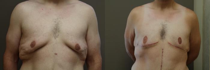 Before & After Gallery Of The Better Body Shop MedSpa In TX