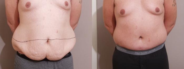 Body Contouring After Weight Loss Before and After Pictures Case 377, Albany & Latham, New York