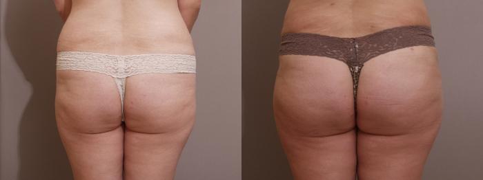 Brazilian Buttock Lift Case 138 Before & After View #1 | Webster, TX | Houston Plastic and Reconstructive Surgery