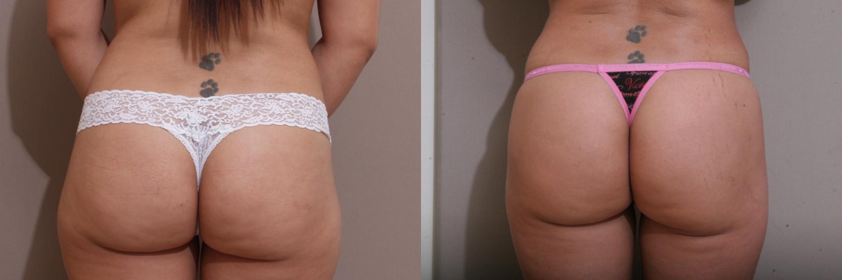 Brazilian Buttock Lift Case 139 Before & After View #1 | Webster, TX | Houston Plastic and Reconstructive Surgery