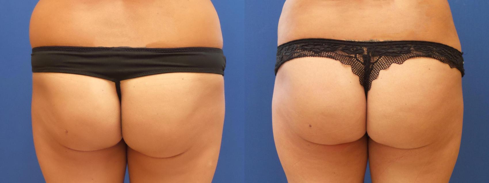 Brazilian Buttock Lift Case 265 Before & After View #1 | Webster, TX | Houston Plastic and Reconstructive Surgery