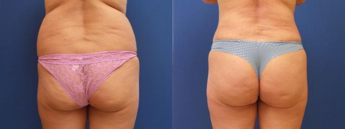 Brazilian Buttock Lift Case 278 Before & After View #1 | Webster, TX | Houston Plastic and Reconstructive Surgery