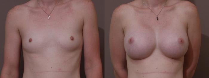 Breast Augmentation Case 113 Before & After View #1 | Webster, TX | Houston Plastic and Reconstructive Surgery