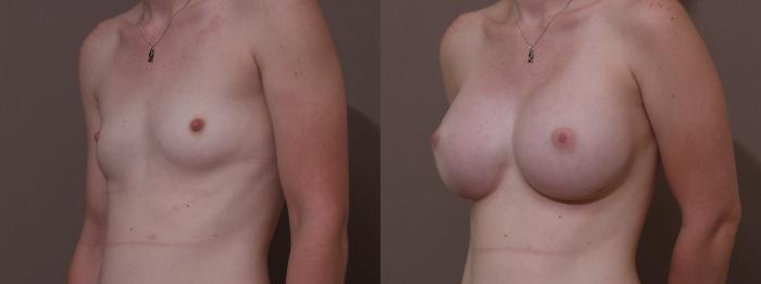 Breast Augmentation Case 113 Before & After View #2 | Webster, TX | Houston Plastic and Reconstructive Surgery