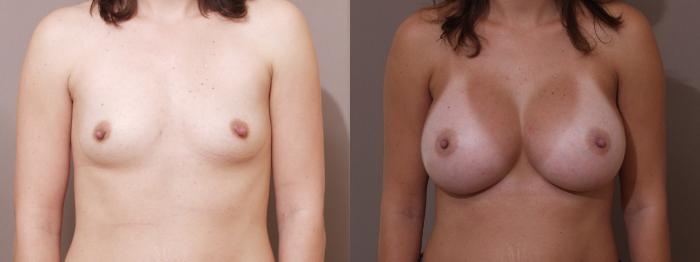 Breast Augmentation Case 12 Before & After View #1 | Webster, TX | Houston Plastic and Reconstructive Surgery