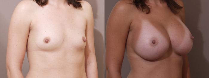 Breast Augmentation Case 12 Before & After View #2 | Webster, TX | Houston Plastic and Reconstructive Surgery