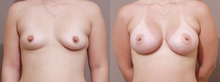 Breast Augmentation Case 120 Before & After View #1 | Webster, TX | Houston Plastic and Reconstructive Surgery