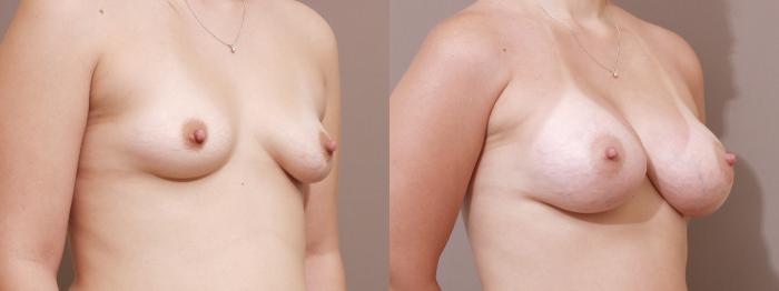 Breast Augmentation Case 120 Before & After View #2 | Webster, TX | Houston Plastic and Reconstructive Surgery