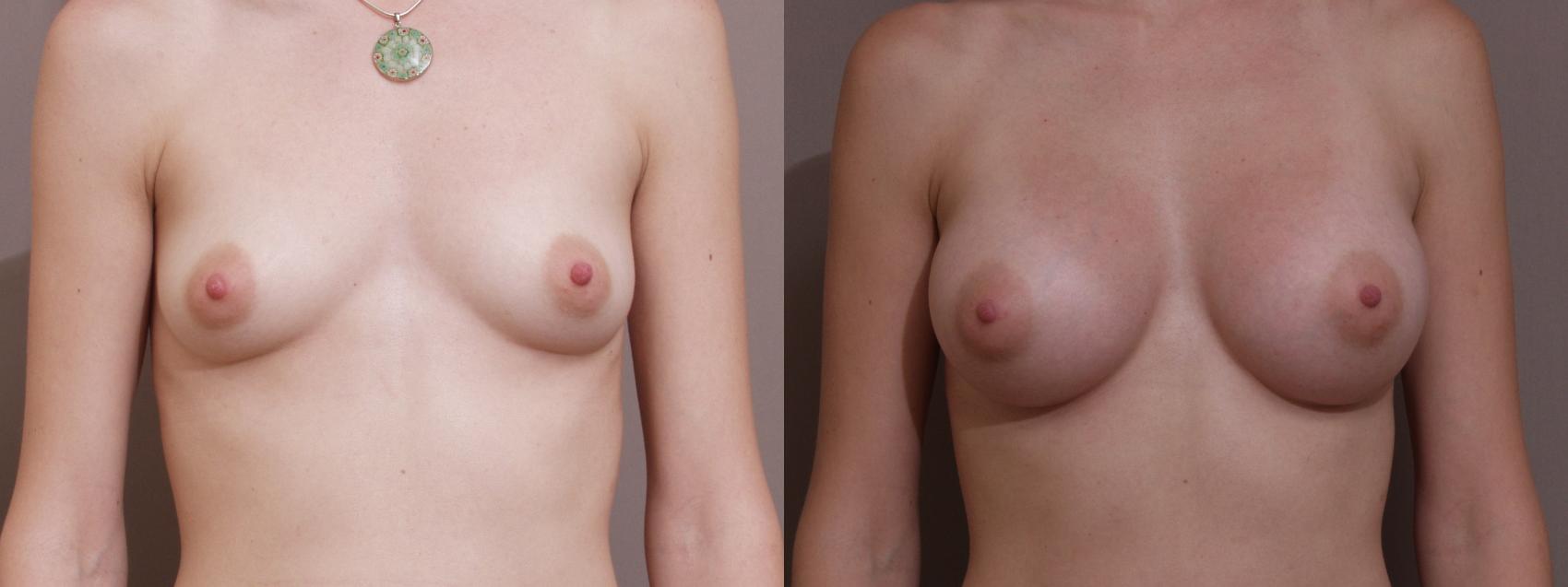 Breast Augmentation Case 129 Before & After View #1 | Webster, TX | Houston Plastic and Reconstructive Surgery
