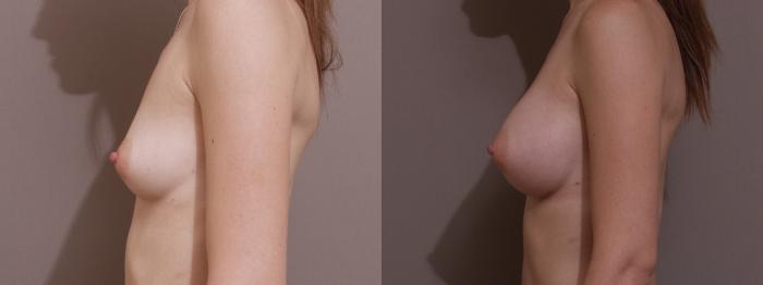 Breast Augmentation Case 129 Before & After View #2 | Webster, TX | Houston Plastic and Reconstructive Surgery