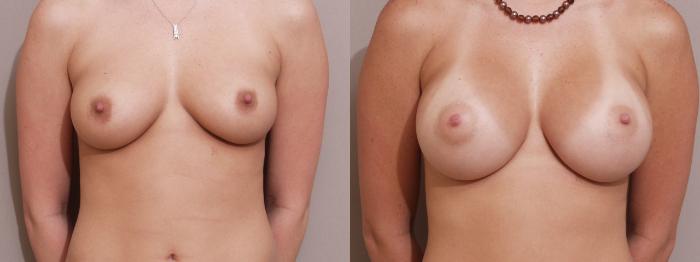 Breast Augmentation Case 130 Before & After View #1 | Webster, TX | Houston Plastic and Reconstructive Surgery
