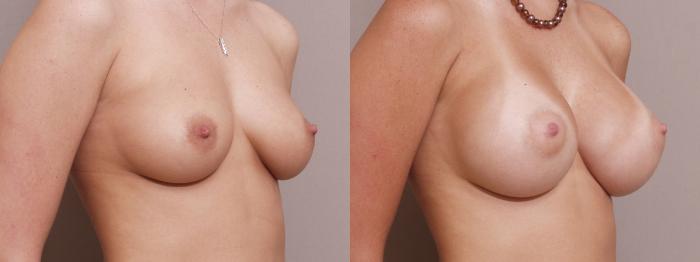 Breast Augmentation Case 130 Before & After View #2 | Webster, TX | Houston Plastic and Reconstructive Surgery