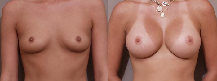 Breast Augmentation Case 133 Before & After View #1 | Webster, TX | Houston Plastic and Reconstructive Surgery