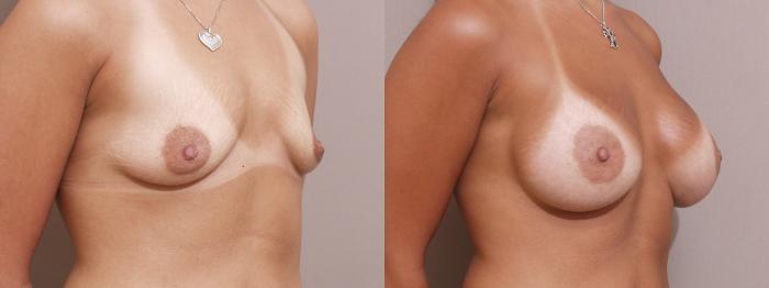 Breast Augmentation Case 140 Before & After View #2 | Webster, TX | Houston Plastic and Reconstructive Surgery