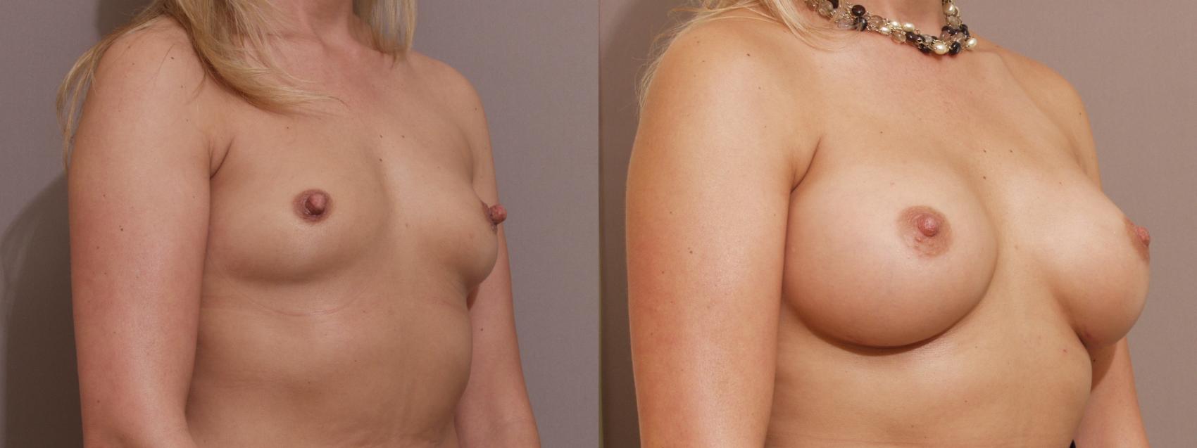 Breast Augmentation Case 141 Before & After View #1 | Webster, TX | Houston Plastic and Reconstructive Surgery