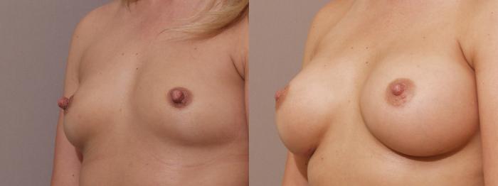Breast Augmentation Case 141 Before & After View #2 | Webster, TX | Houston Plastic and Reconstructive Surgery