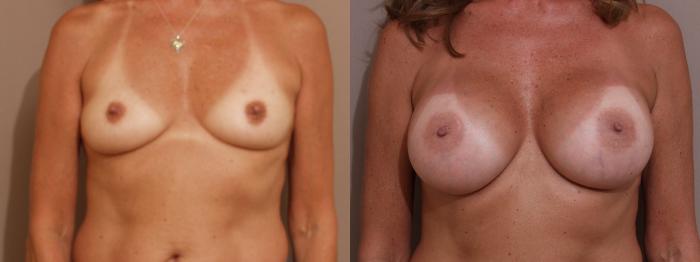 Breast Augmentation Case 142 Before & After View #1 | Webster, TX | Houston Plastic and Reconstructive Surgery