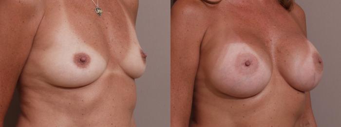 Breast Augmentation Case 142 Before & After View #2 | Webster, TX | Houston Plastic and Reconstructive Surgery