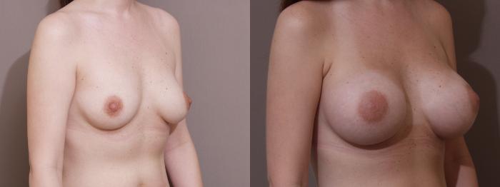 Breast Augmentation Case 143 Before & After View #2 | Webster, TX | Houston Plastic and Reconstructive Surgery
