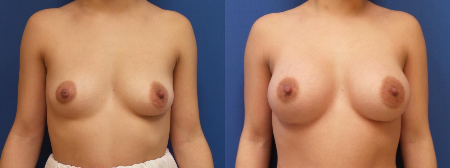 Breast Augmentation Case 145 Before & After View #1 | Webster, TX | Houston Plastic and Reconstructive Surgery