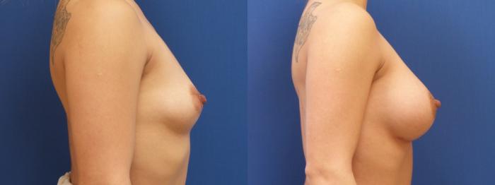 Breast Augmentation Case 145 Before & After View #2 | Webster, TX | Houston Plastic and Reconstructive Surgery