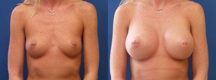 Breast Augmentation Case 147 Before & After View #1 | Webster, TX | Houston Plastic and Reconstructive Surgery