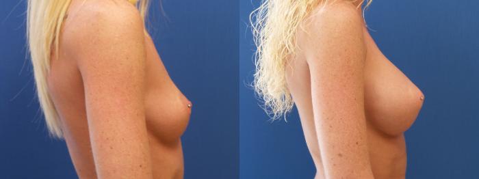 Breast Augmentation Case 147 Before & After View #2 | Webster, TX | Houston Plastic and Reconstructive Surgery