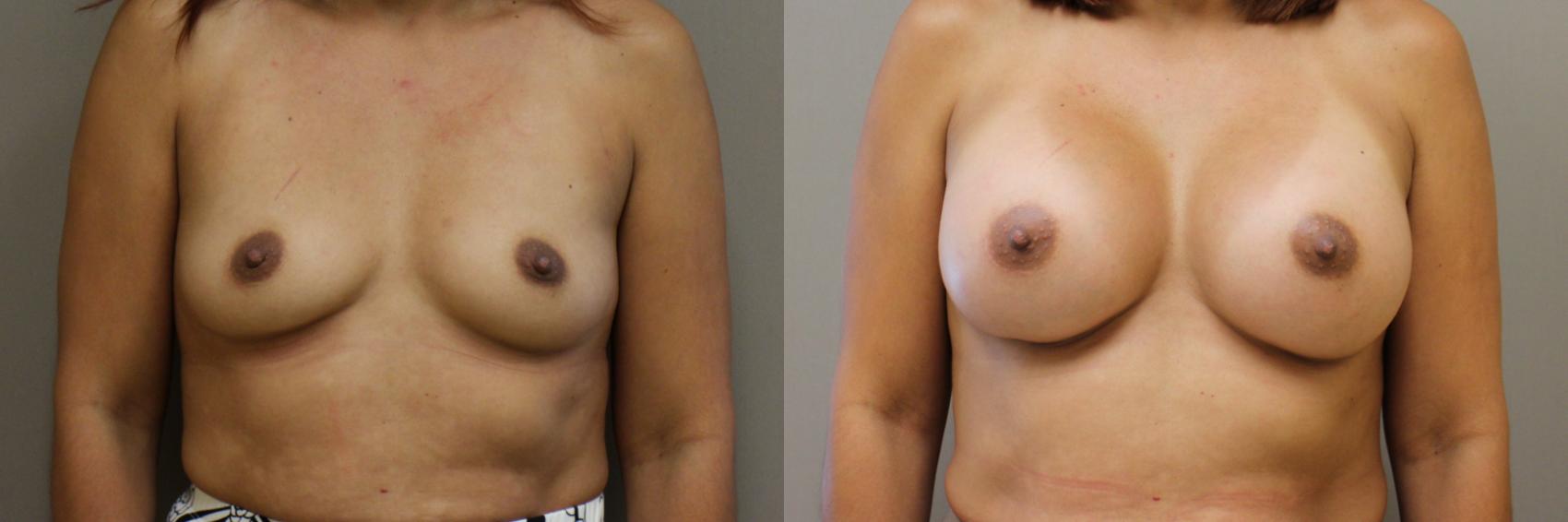 Breast Augmentation Case 150 Before & After View #1 | Webster, TX | Houston Plastic and Reconstructive Surgery