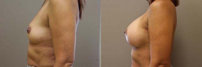 Breast Augmentation Case 150 Before & After View #2 | Webster, TX | Houston Plastic and Reconstructive Surgery