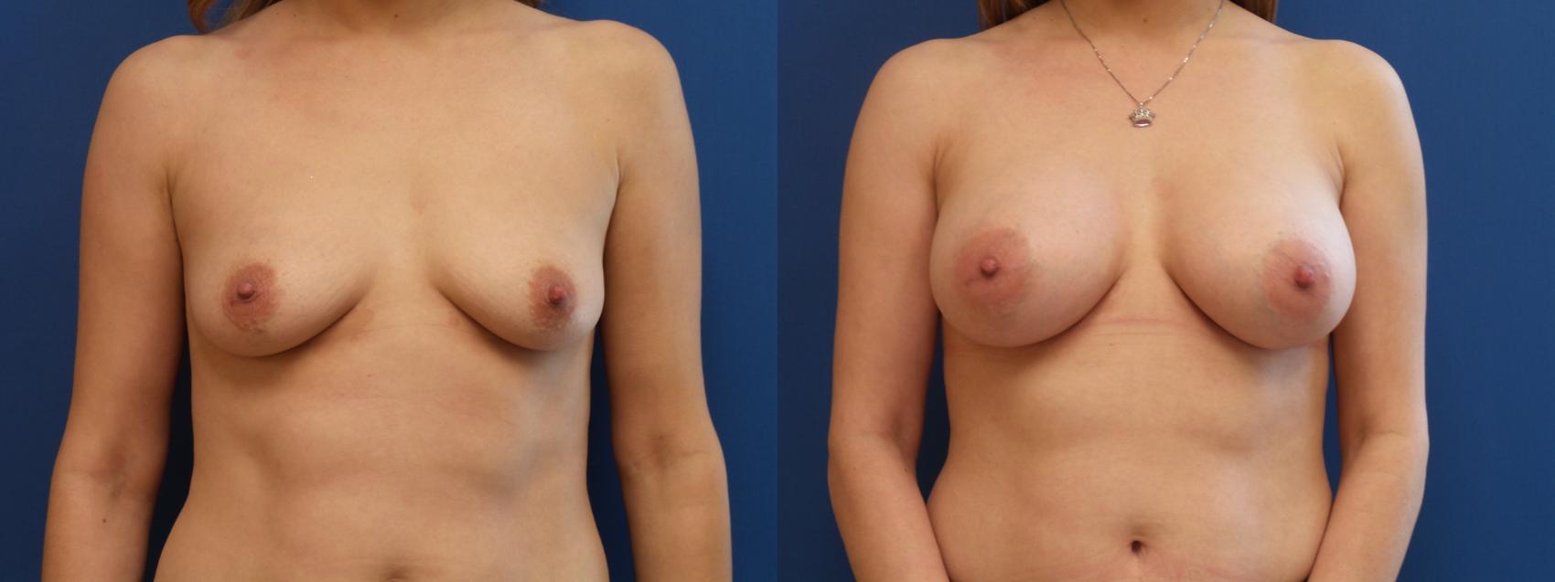 Breast Augmentation Case 151 Before & After View #1 | Webster, TX | Houston Plastic and Reconstructive Surgery