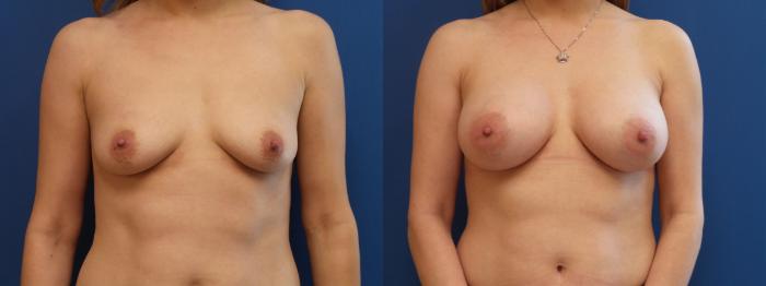 Breast Augmentation Case 151 Before & After View #1 | Webster, TX | Houston Plastic and Reconstructive Surgery