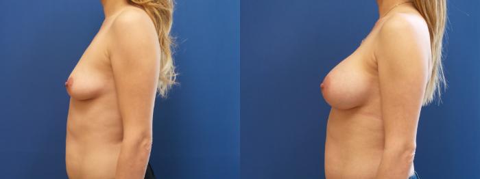 Breast Augmentation Case 151 Before & After View #2 | Webster, TX | Houston Plastic and Reconstructive Surgery