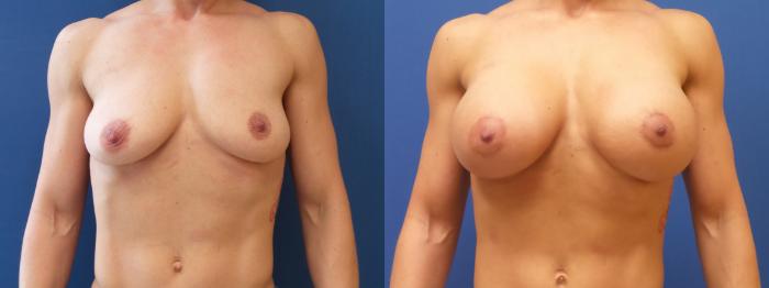 Breast Augmentation Case 163 Before & After View #1 | Webster, TX | Houston Plastic and Reconstructive Surgery