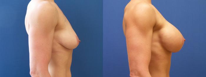 Breast Augmentation Case 163 Before & After View #2 | Webster, TX | Houston Plastic and Reconstructive Surgery